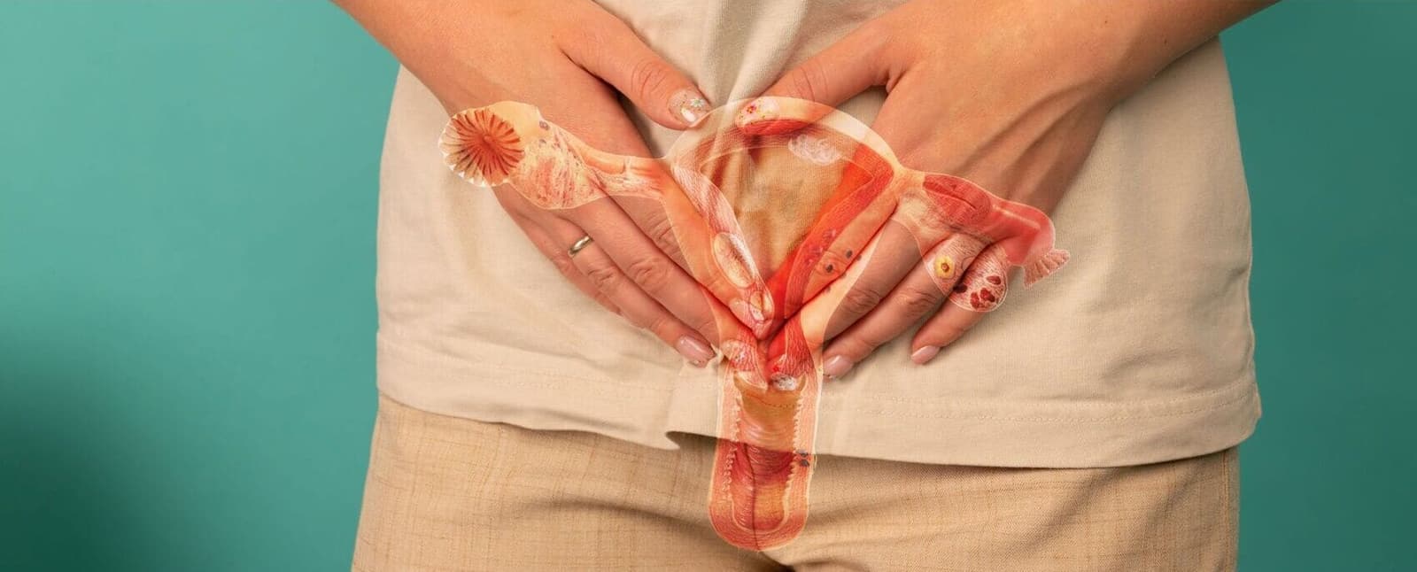 Endometriosis: “Silent” Signs Many Women Normalize